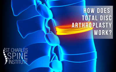 How Does Total Disc Arthroplasty Work?