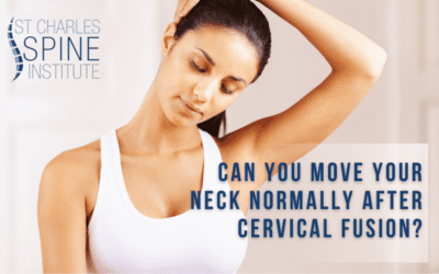 Can You Move Your Neck Normally After Cervical Fusion?