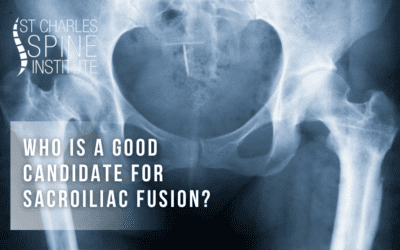 Who Is a Good Candidate For Sacroiliac Fusion?