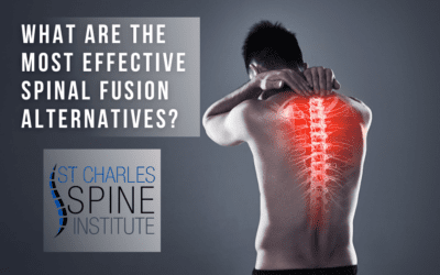What Are the Most Effective Spinal Fusion Alternatives?