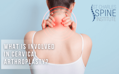 What is Involved In Cervical Arthroplasty
