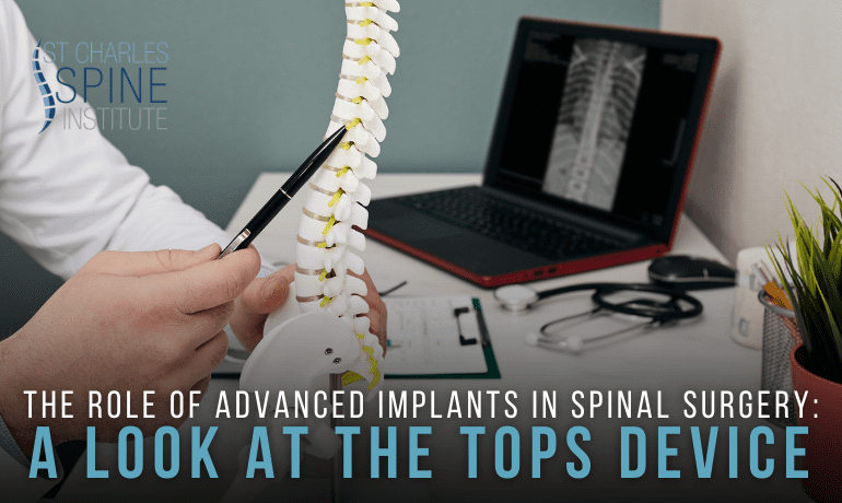 The Role of Advanced Implants in Spinal Surgery- A Look at the TOPS Device